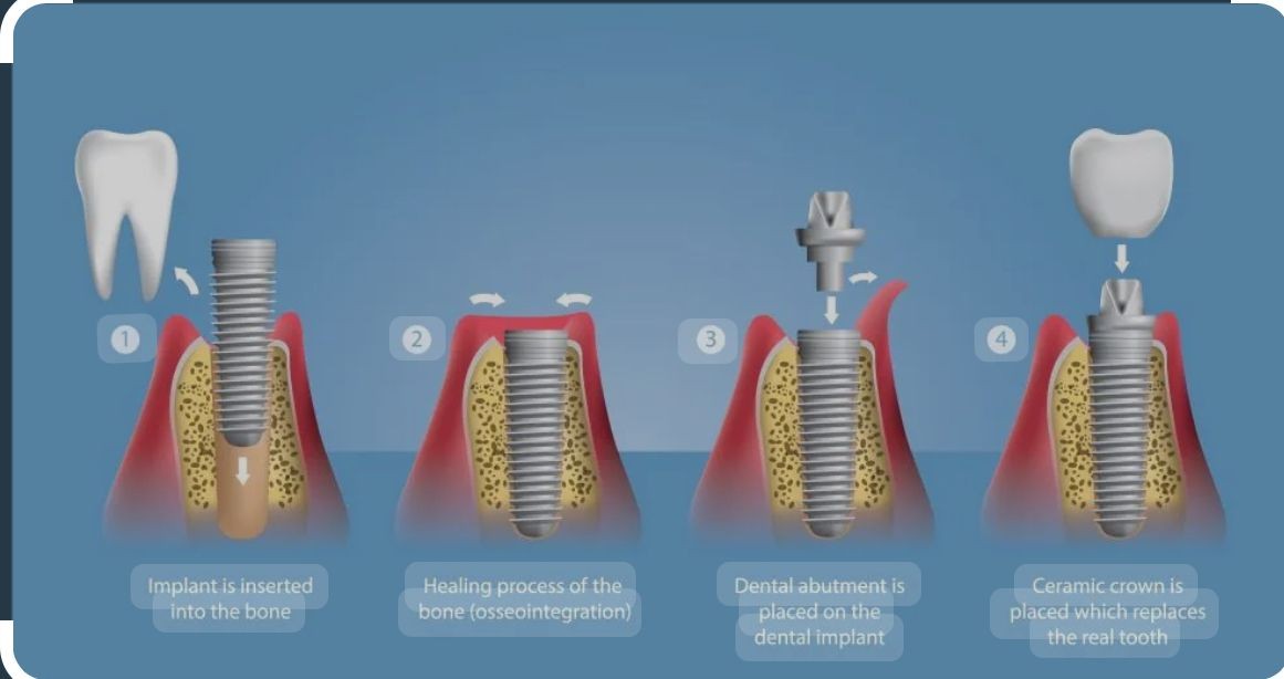 Dental Implants Placement